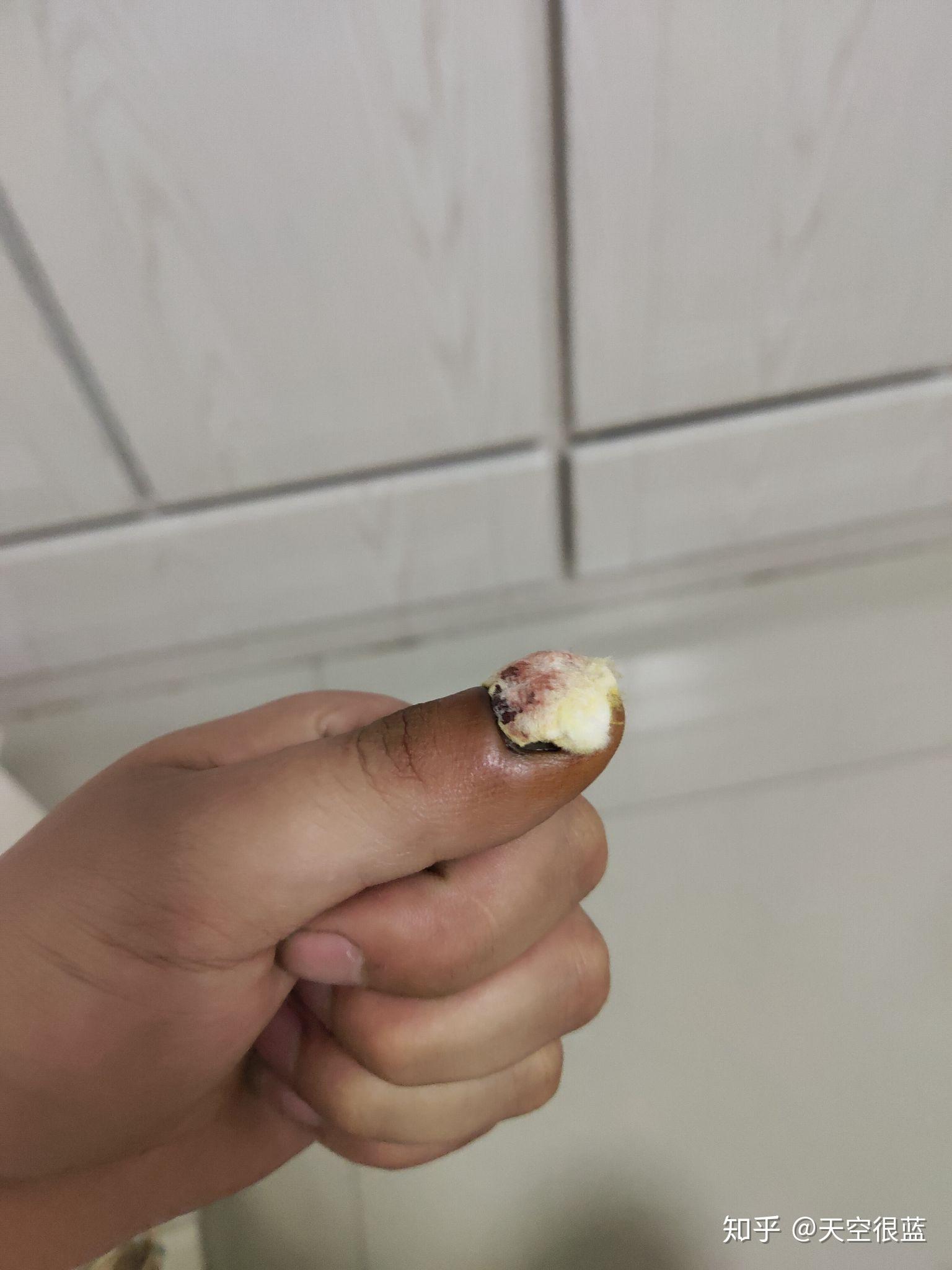 指甲被车门夹瘀血恢复过程
