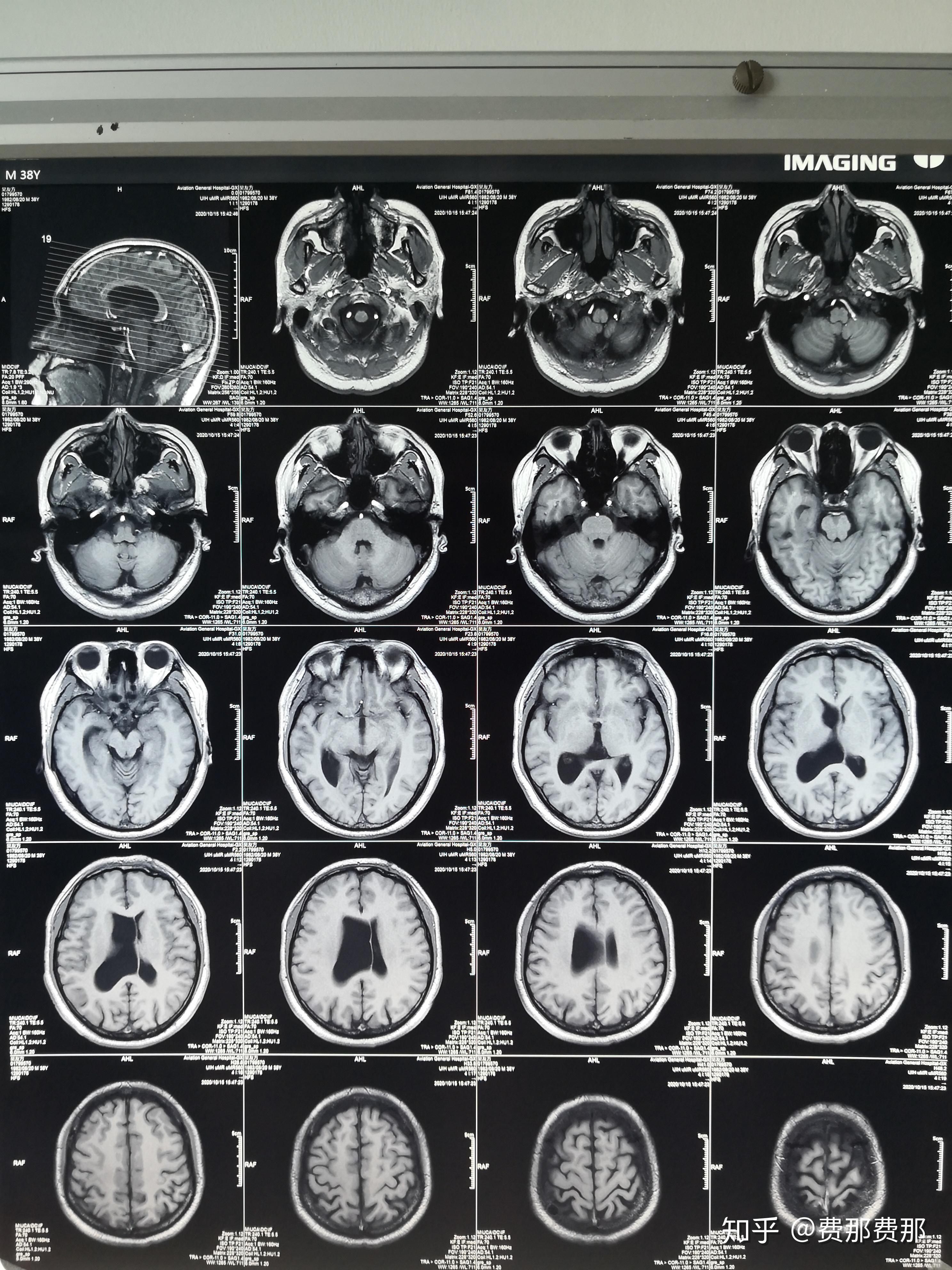 肖庆案例分享神经内镜下治疗脑积水