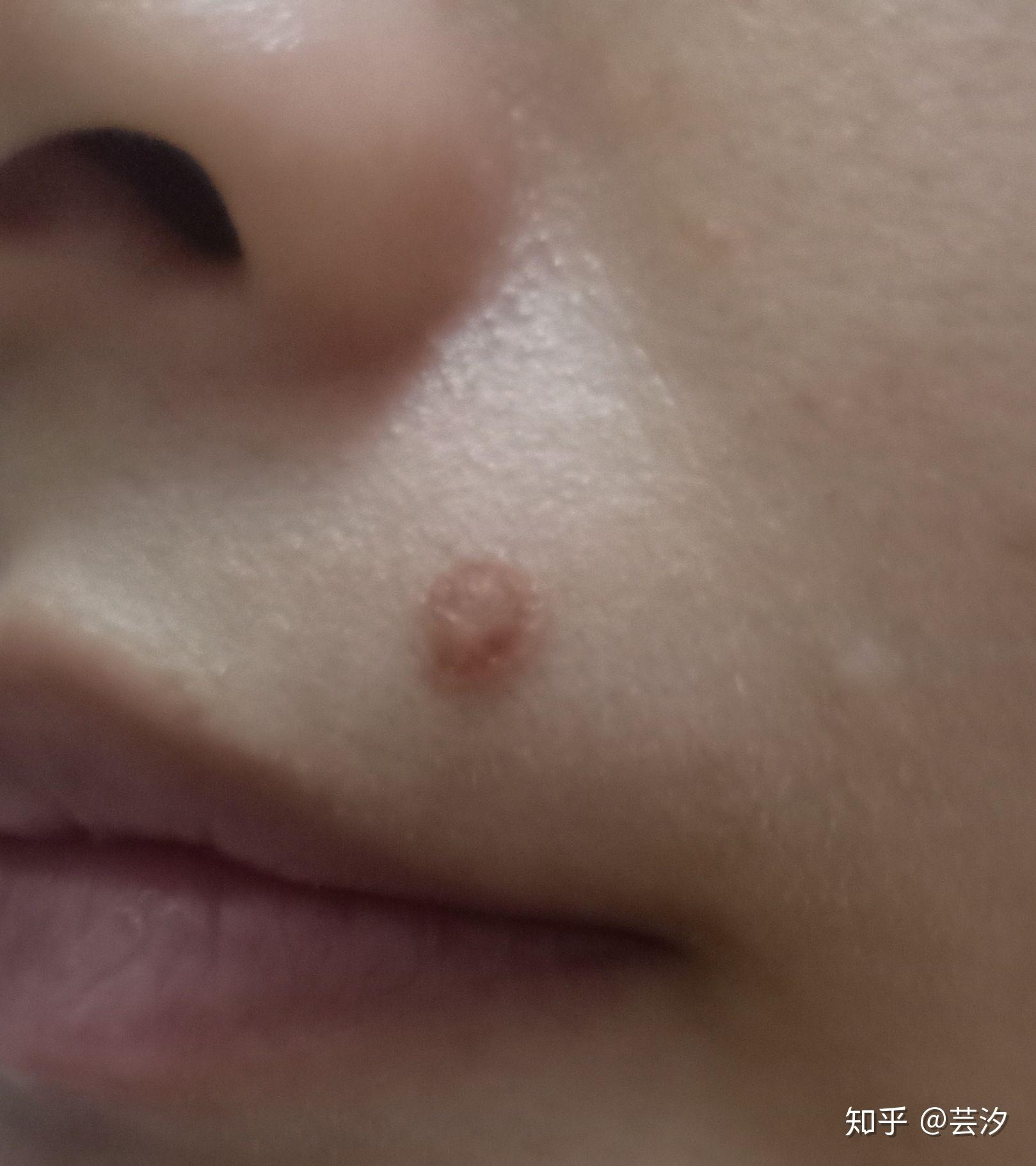 一个关于冷冻祛痣(液氮)的记录贴