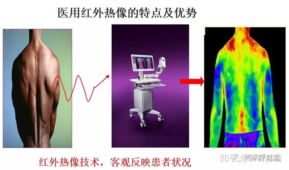 红外热像仪在疼痛诊疗康复中的应用