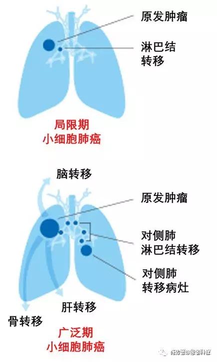 一文读懂放化疗为主的小细胞肺癌的诊断，病理，分期和治疗（上） 知乎