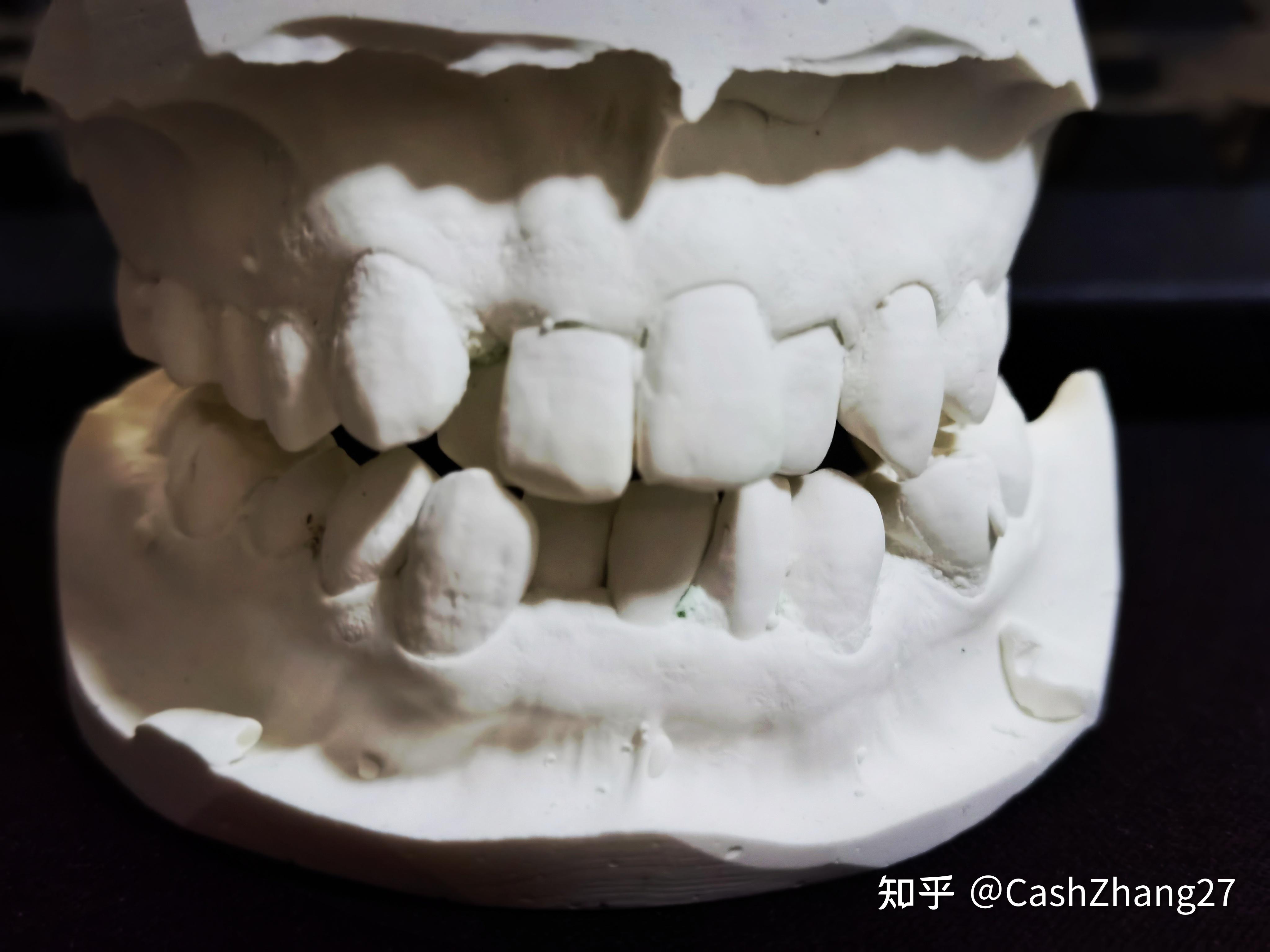 分牙 后戴上左上67右上67的套,中间有个盖儿似的东西(可能是平面导板
