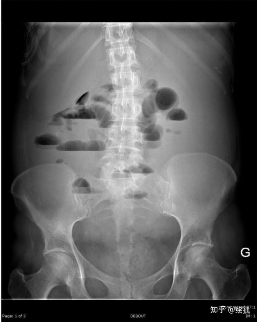 消化系统43肠梗阻