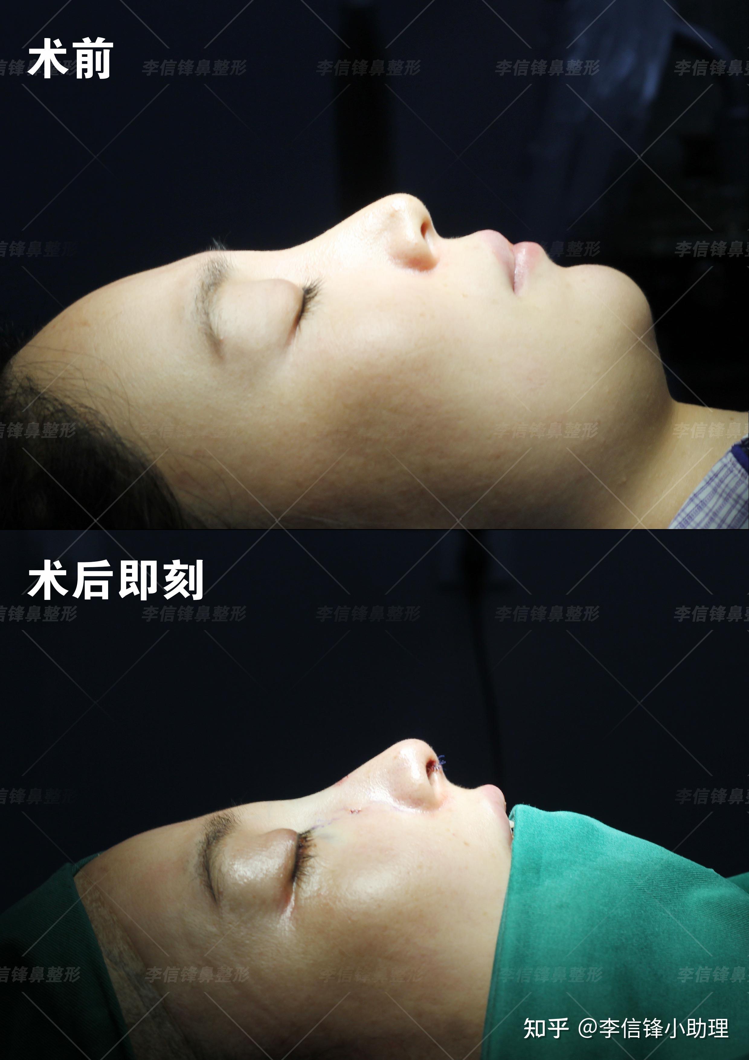 北京做鼻综合术后案例分享-蜜颜优惠