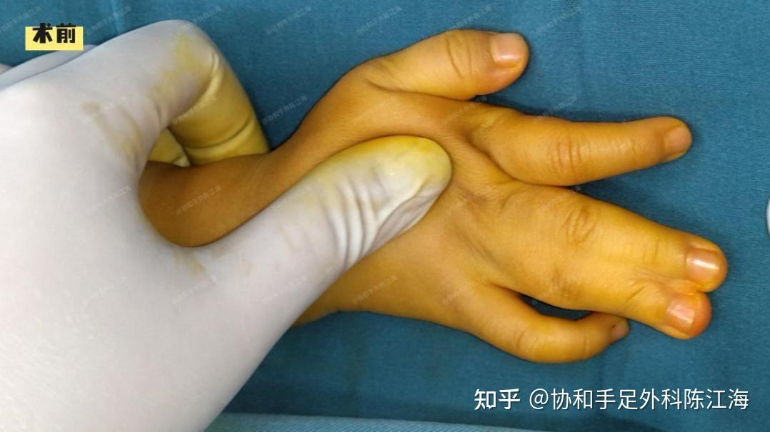 并指免植皮 | 案例25《手指脚趾一次分完,力量和活动都不错》 - 知乎