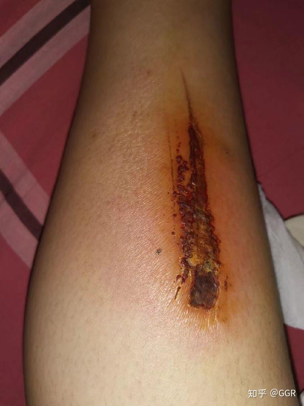 我受伤了一点小伤没有处理好变成了大伤