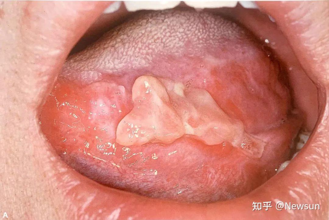 口腔白色线状苔藓图片图片