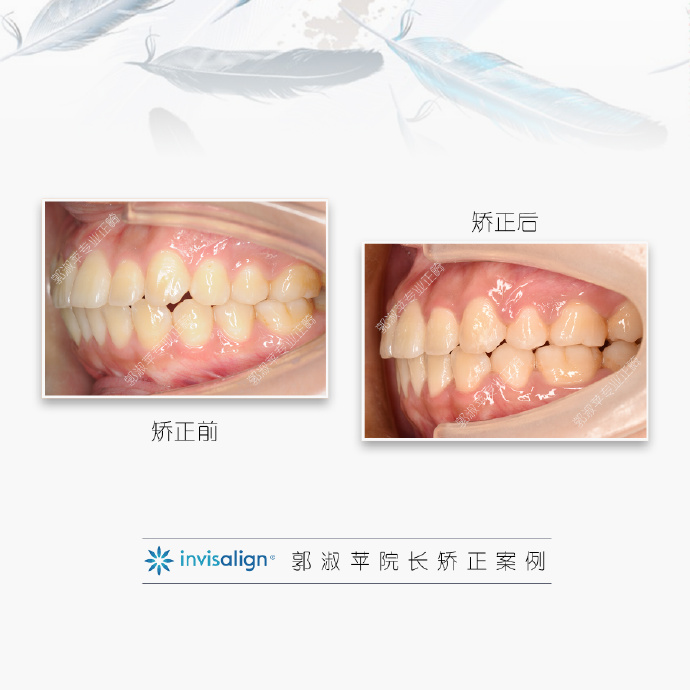 福州隐形矫正前牙唇倾牙齿不齐案例