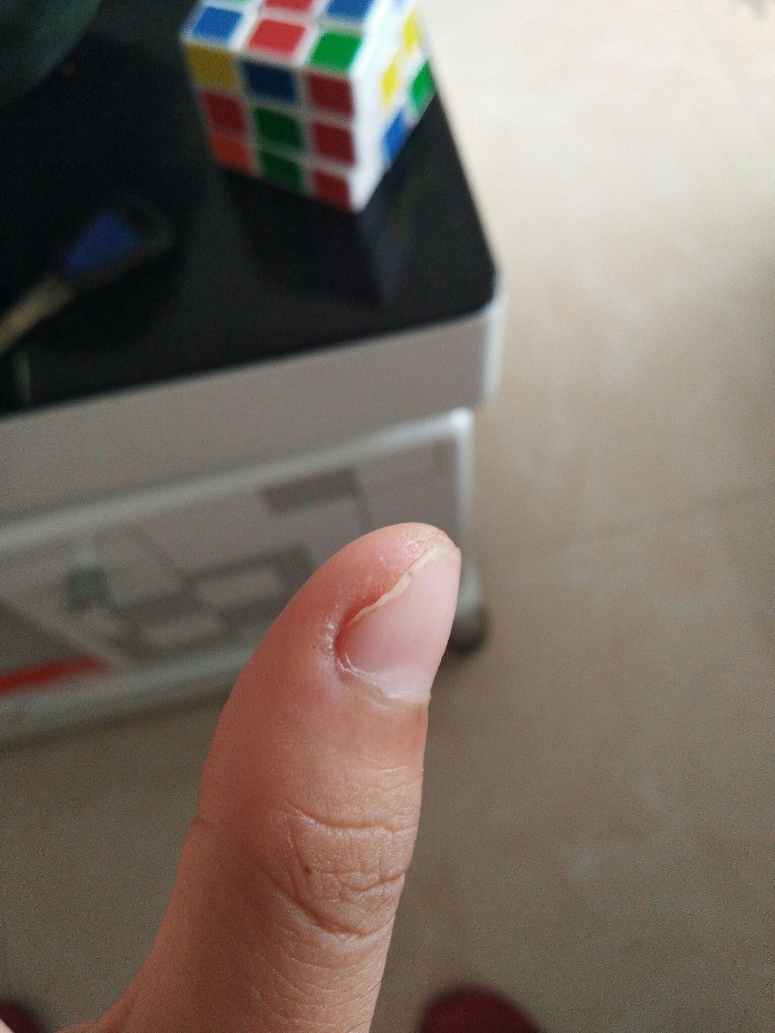 困扰了很多年的甲周疣,在右手的中指上,疣体已