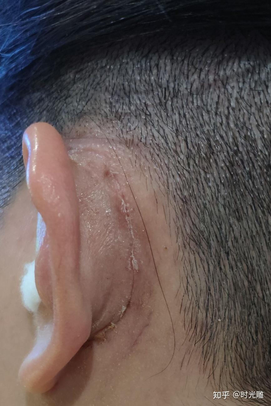 中耳炎耳膜穿孔十几年生活史,终于做手术修补了!