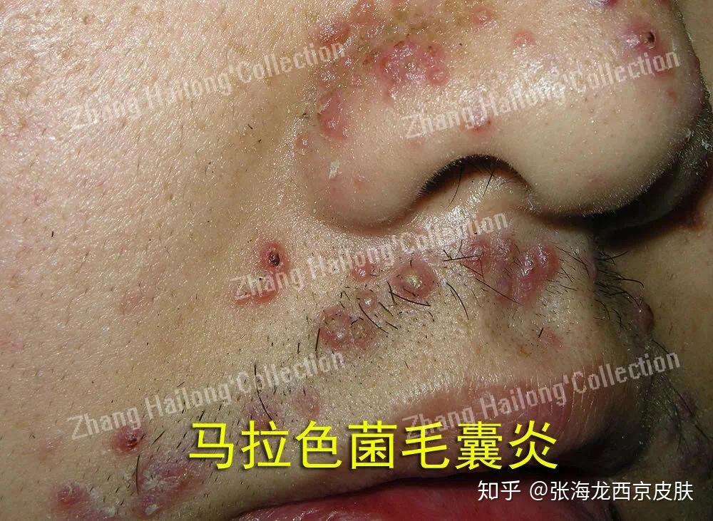 毛周角化鸡皮肤扁平疣(扁平疣和毛周角化区别图)