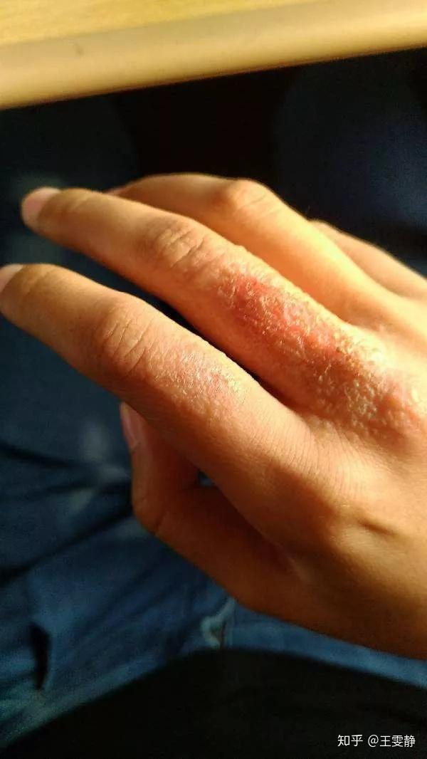 手癣又分为丘疹鳞屑型,水疱型,角化过度型等.