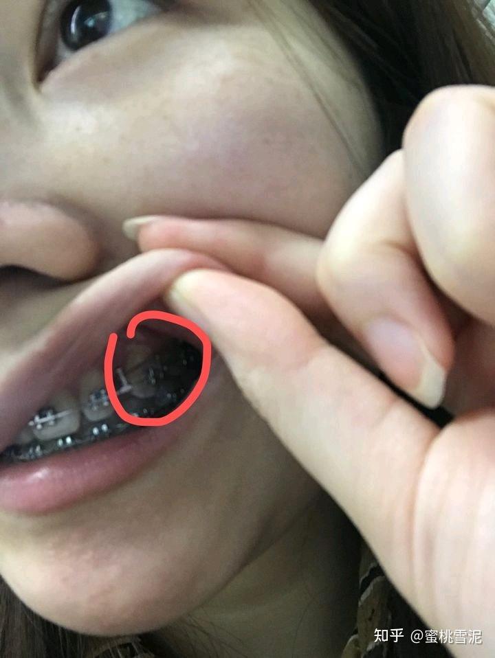 牙缝里的草莓籽发芽了那些我戴牙套期间踩过对坑和清洁神器分享