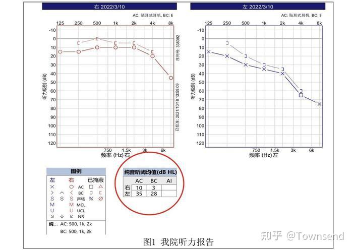 听力报告怎么看?