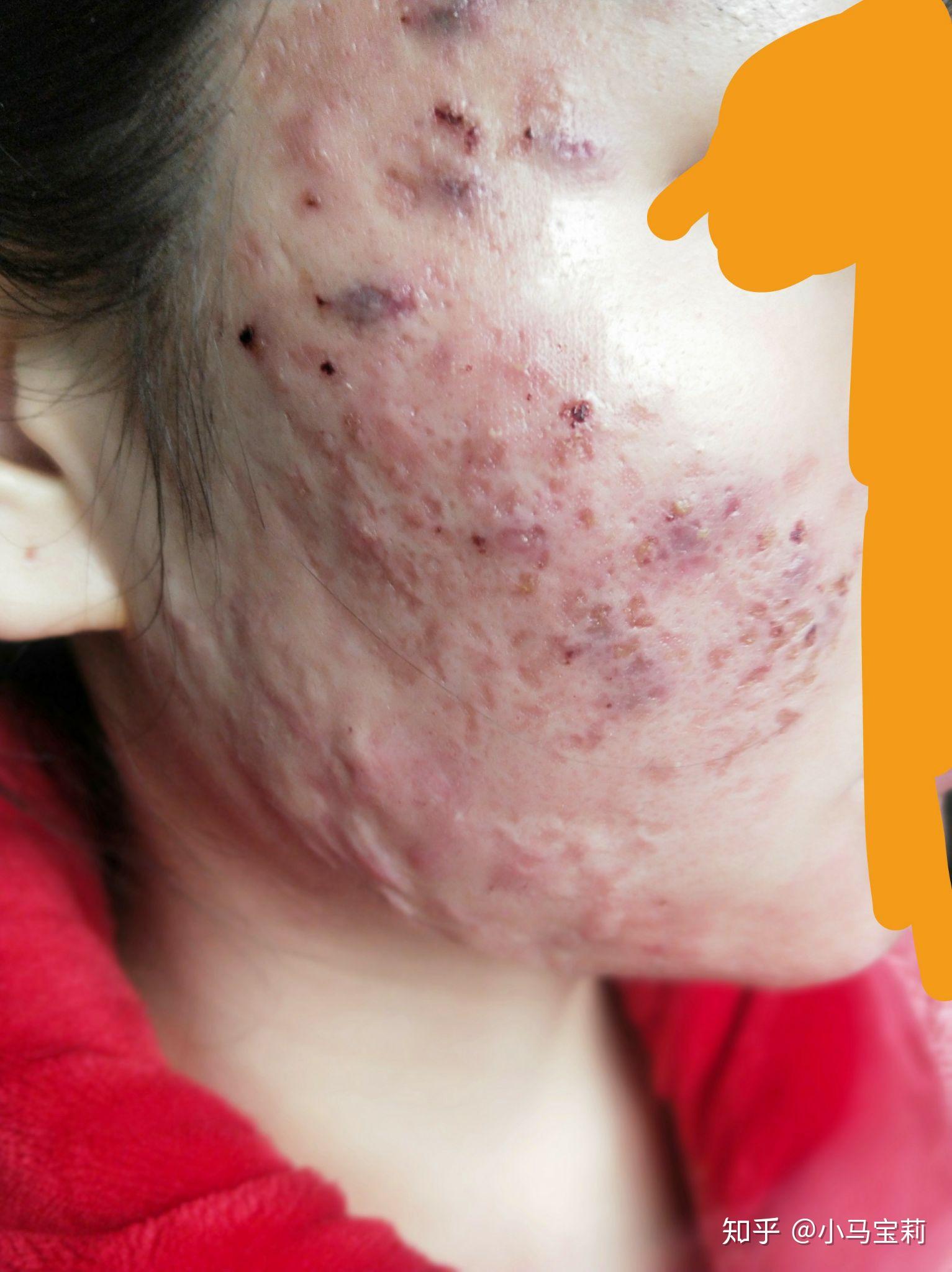 治疗痘坑 - 知乎