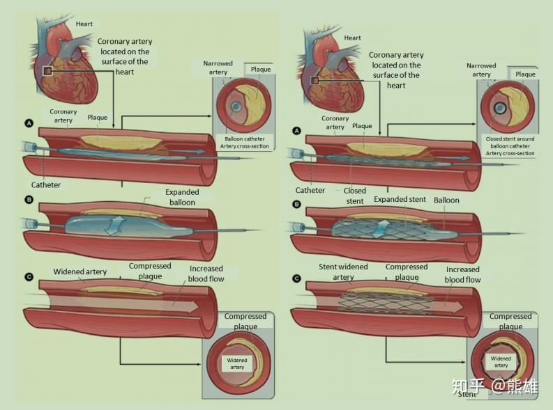 介入(经皮冠状动脉腔内血管成形术(ptca)或支架植入术)和心脏搭桥手术