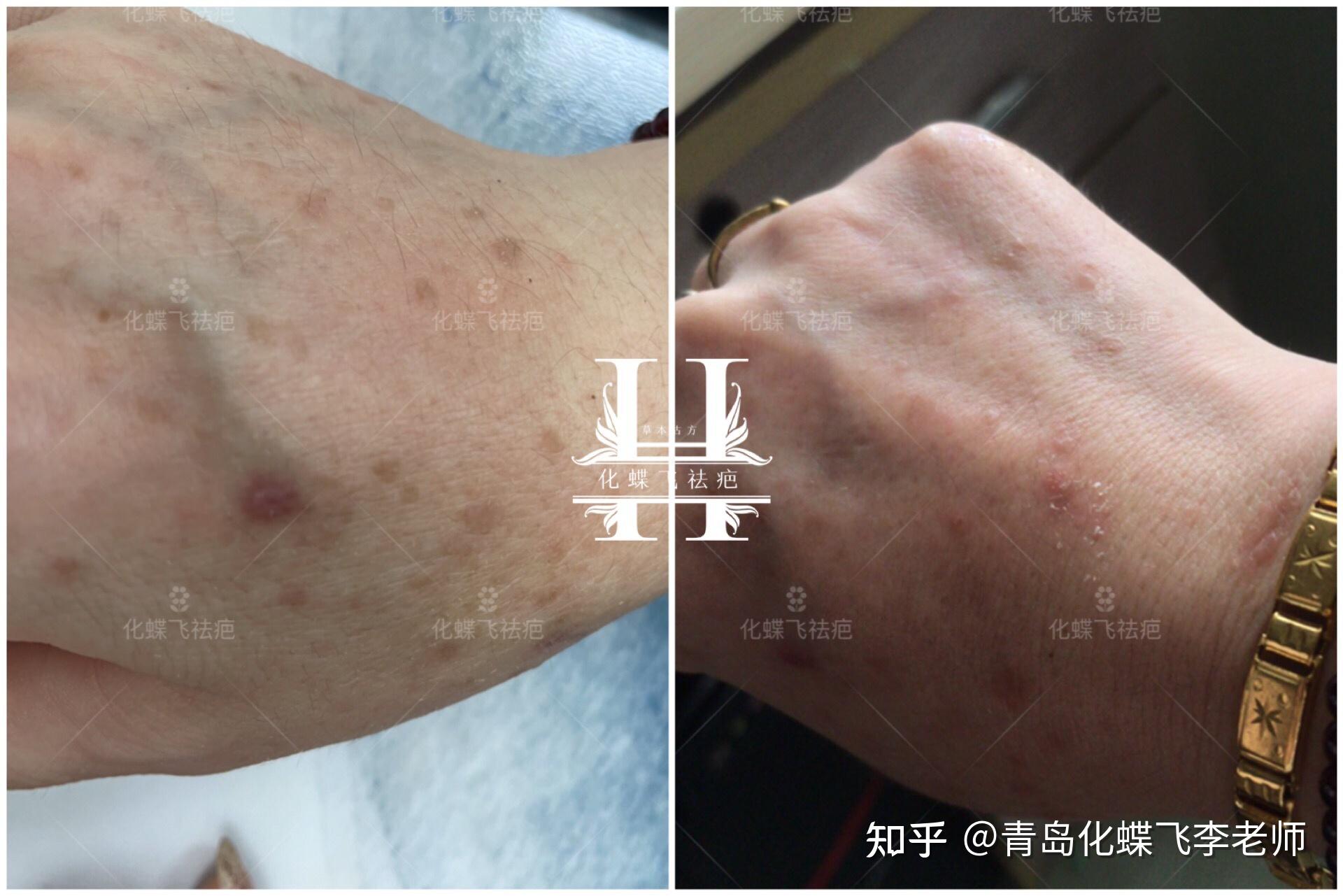 色素沉淀疤痕淡化