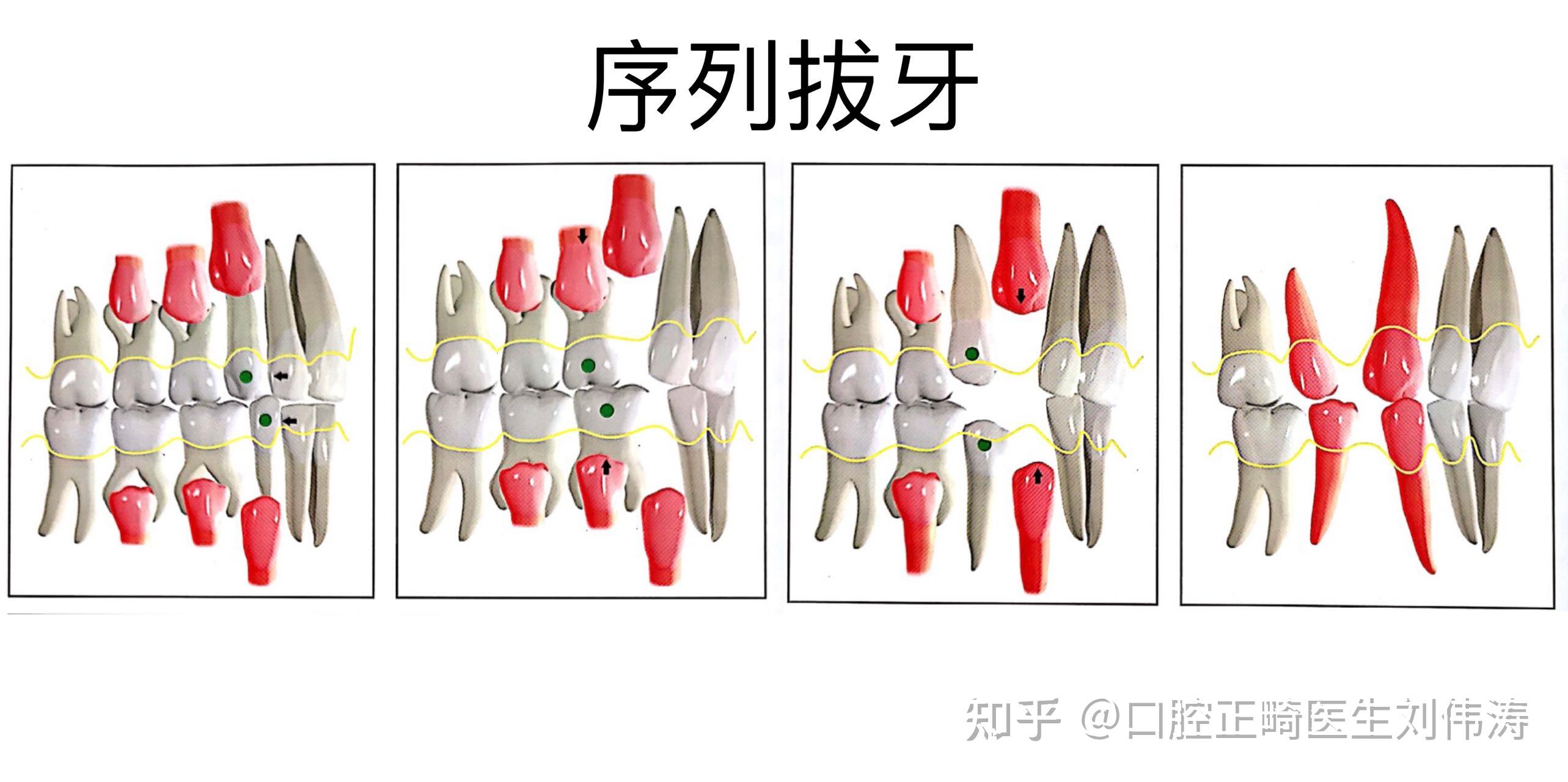 早期阻断性矫治(四)牙列拥挤的矫治 - 知乎