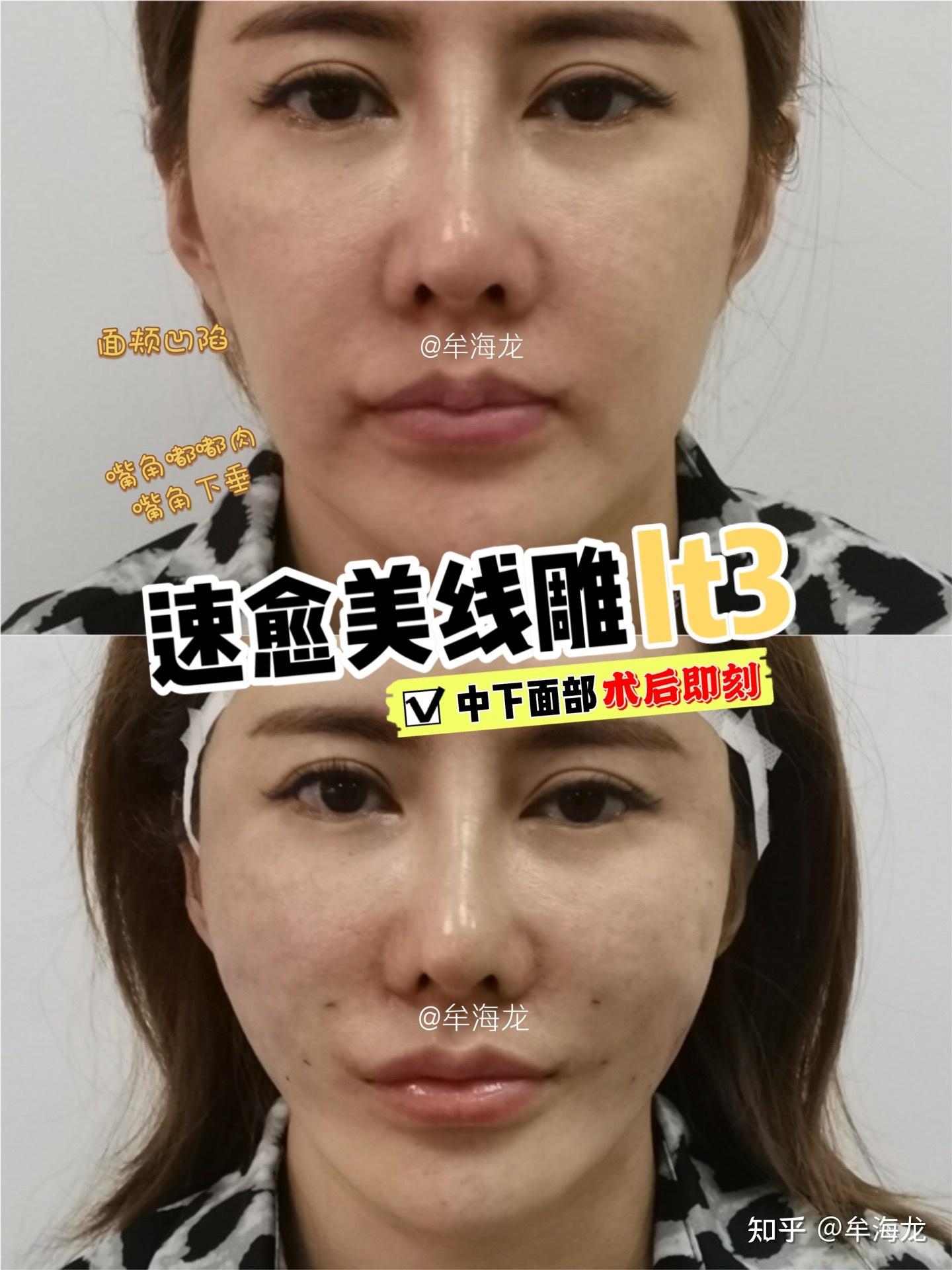 肉毒杆菌注射的女性的脸面颊图片下载 - 觅知网