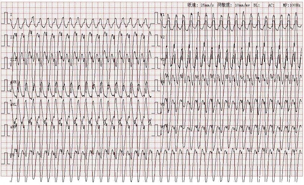 心电图图库丨室性心动过速系列 