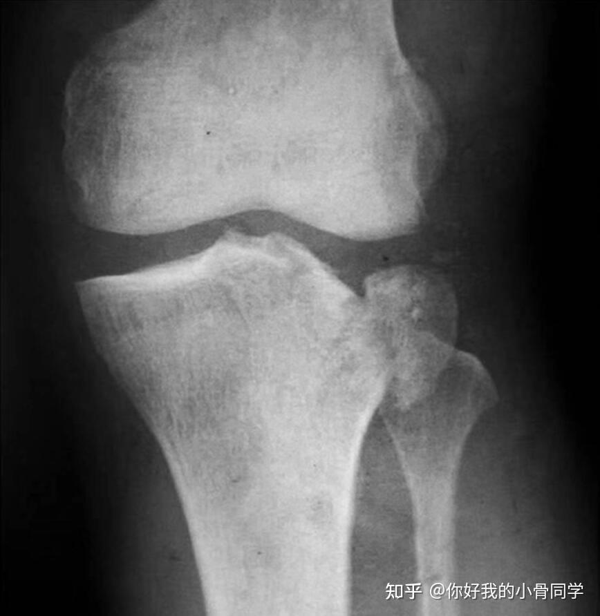 腓骨小头骨折多久能好?怎么治疗?