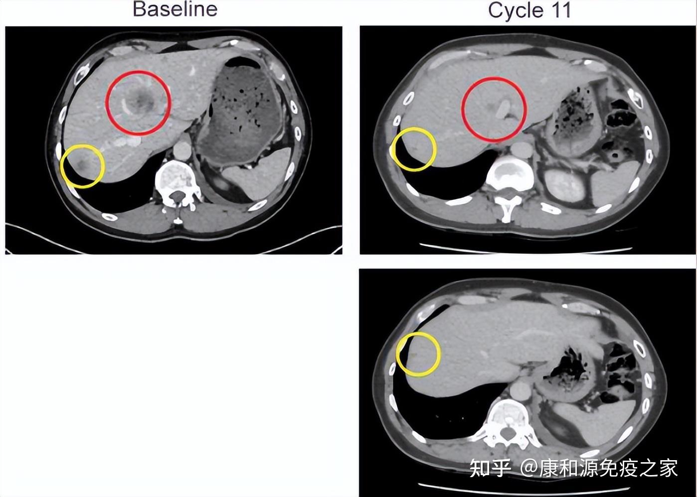 肺癌新药icp-723成为ntrk阳性肿瘤患者抗癌新希望!