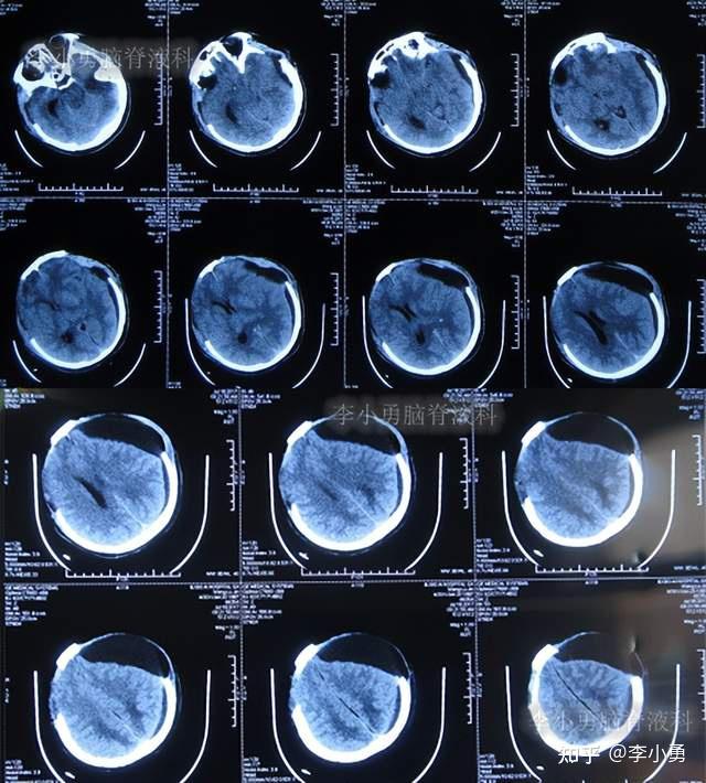 一,李小勇脑脊液科入院前病史患者于2017年6月21日,在工作执勤时意外