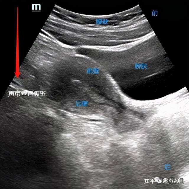 超声下如何区分宫体前后壁?
