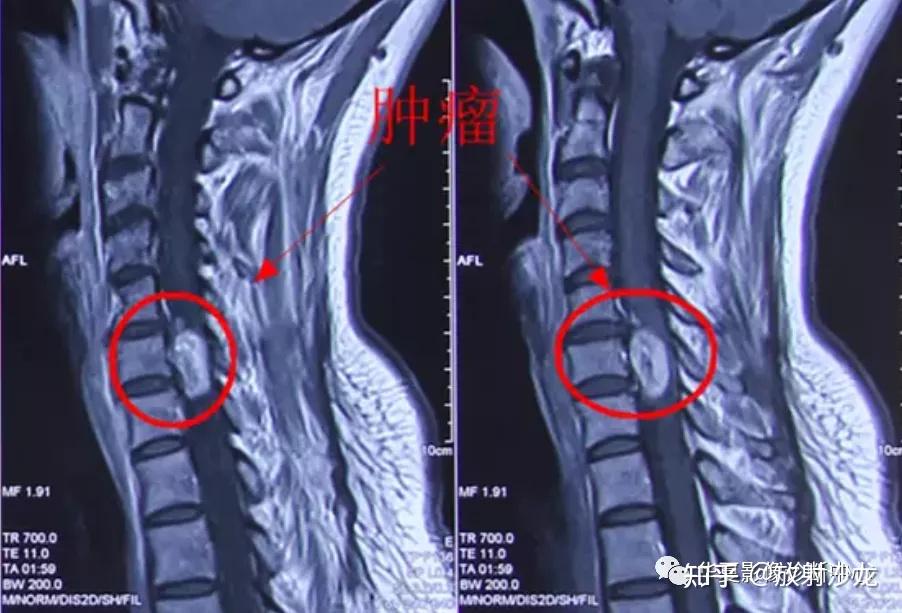 在mri上腫瘤呈長t1長t2信號,囊變部分信號異常及明顯,增強掃描實質