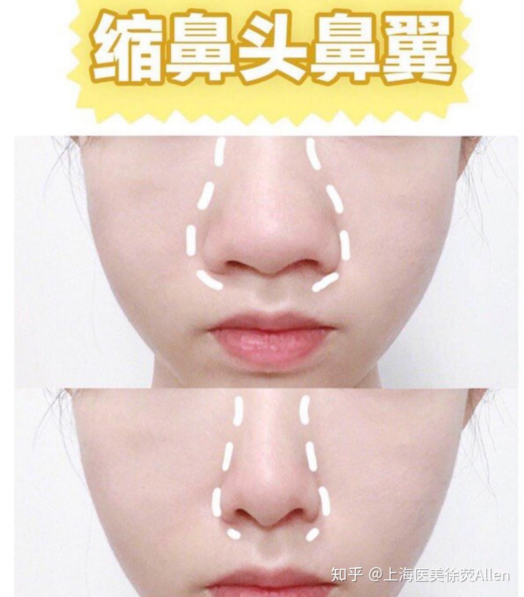 鼻头肥大鼻子的那点事