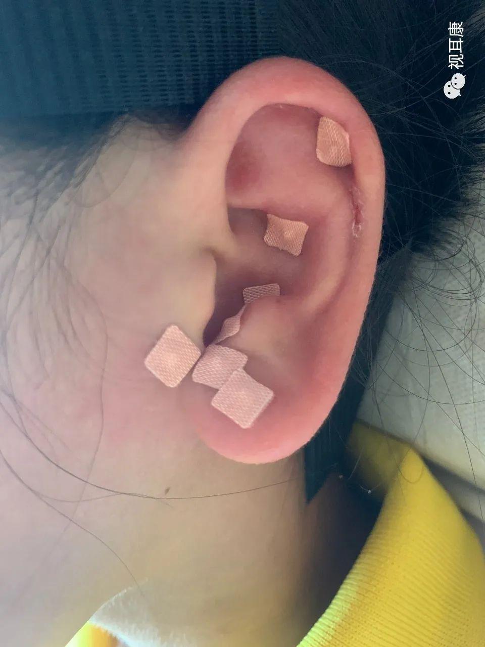 中医耳穴贴压配合穴位按摩干预青少年假性近视