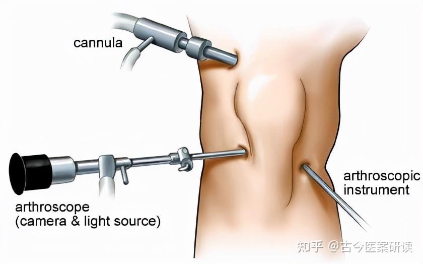 关节镜治疗膝关节骨性关节炎怎么样?一篇论文告诉我们这些知识 - 知乎