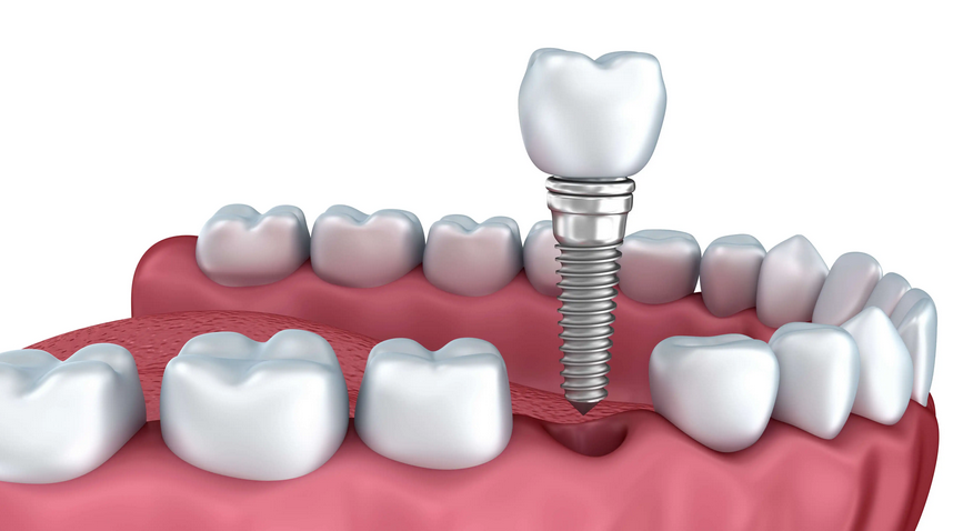 广州种牙医院医生哪个好广州大医院种牙多少钱广州士卓曼种植体质量