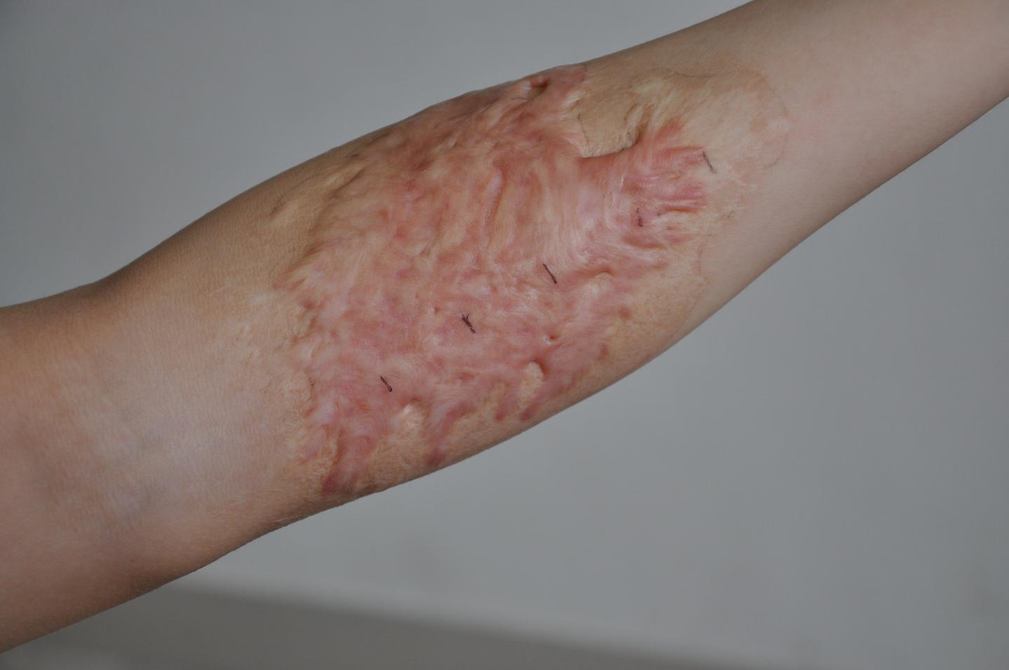 疤痕多久可以完全淡化 v2-dc7b14348460a35452c08991d66b3db3_1440w.jpg?source=172ae18b