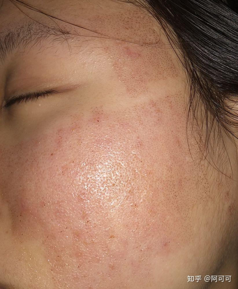 点阵激光第四天