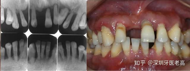 一名31歲的男子,2年前因牙齦腫就診,當時醫生診斷為侵襲性牙周炎,但是