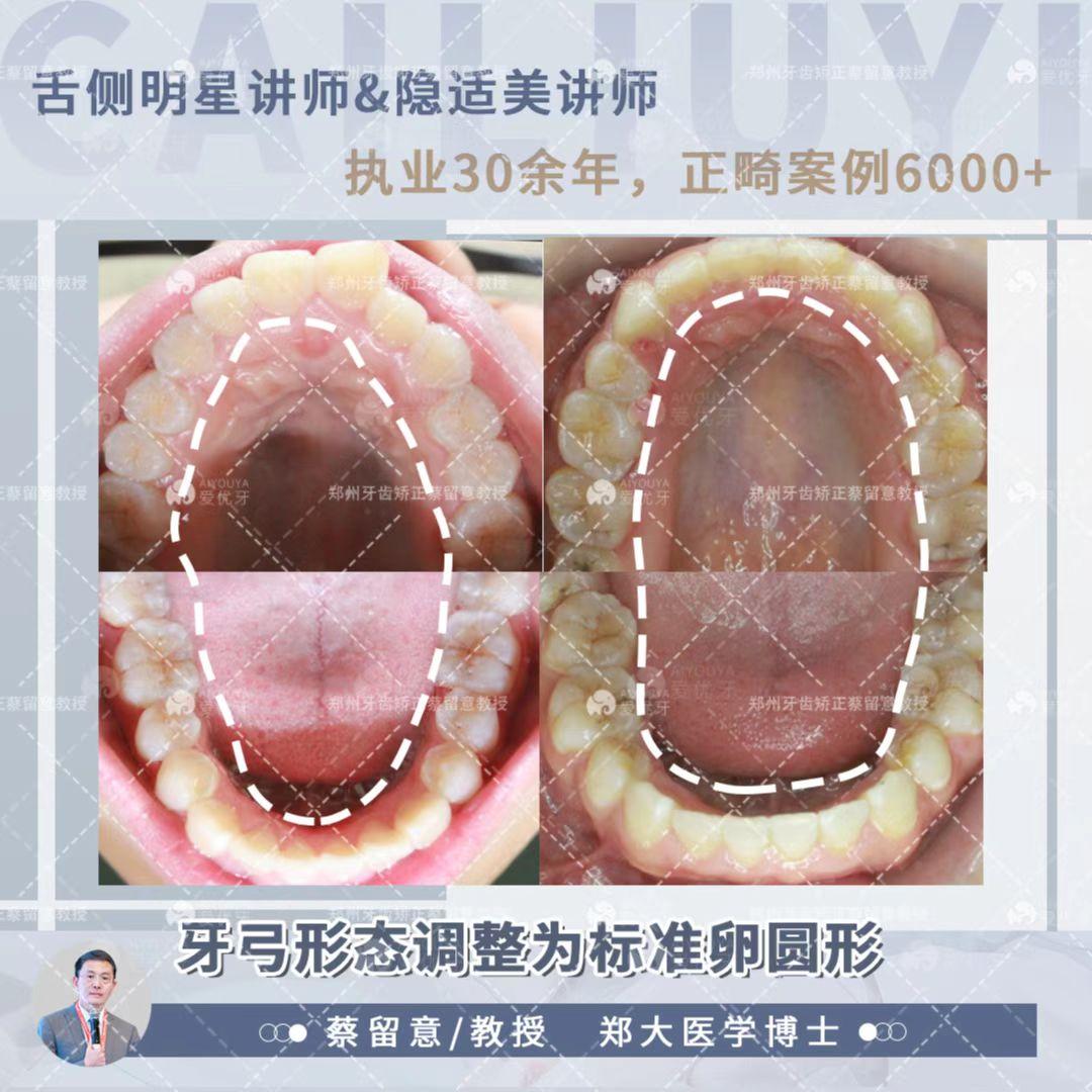 郑州牙齿矫正|舌侧矫正案例：骨性下颌前突（地包天）+面部偏斜 - 知乎