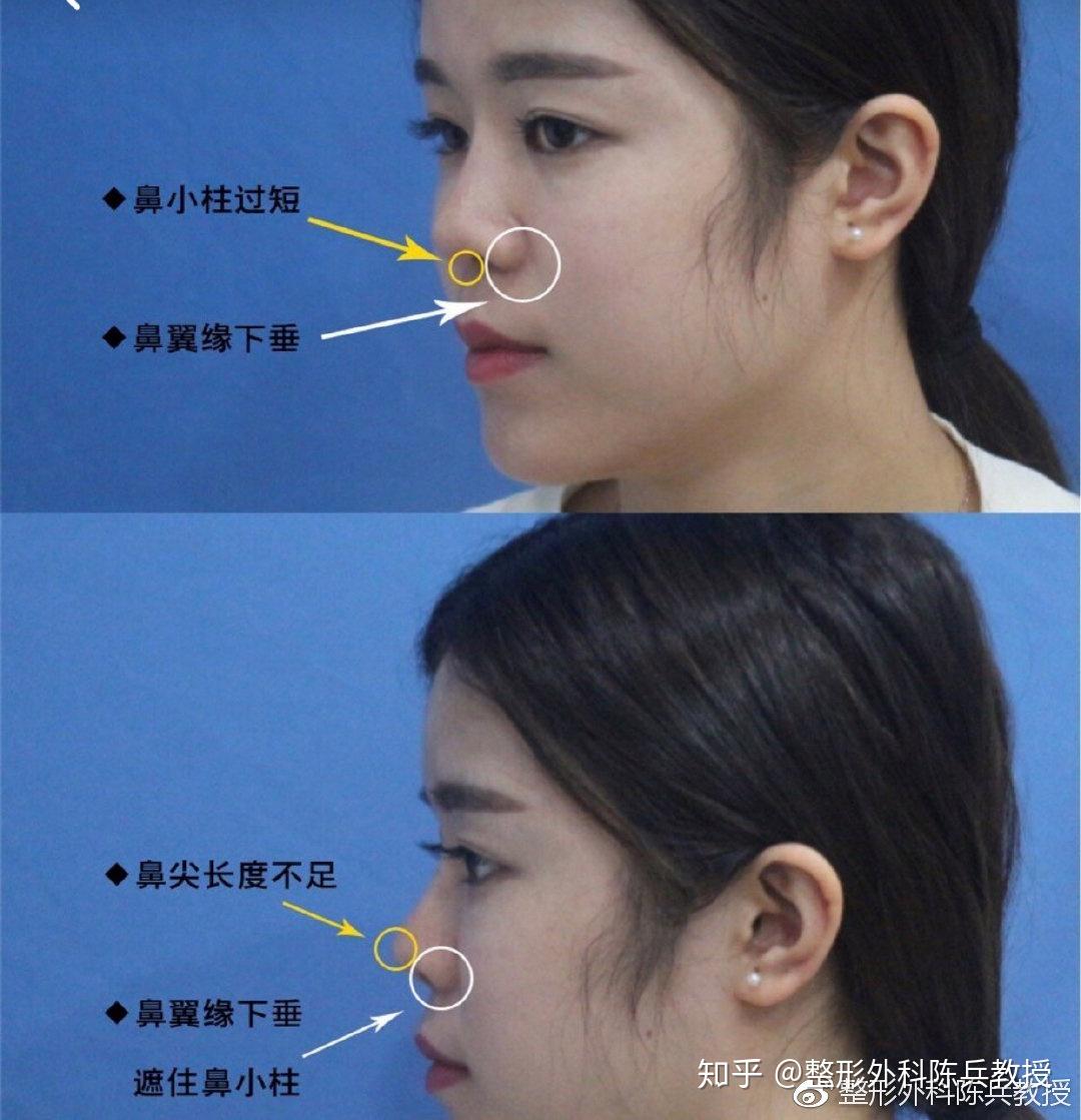 缩小鼻翼整形分析附术前术后注意事项 - 知乎