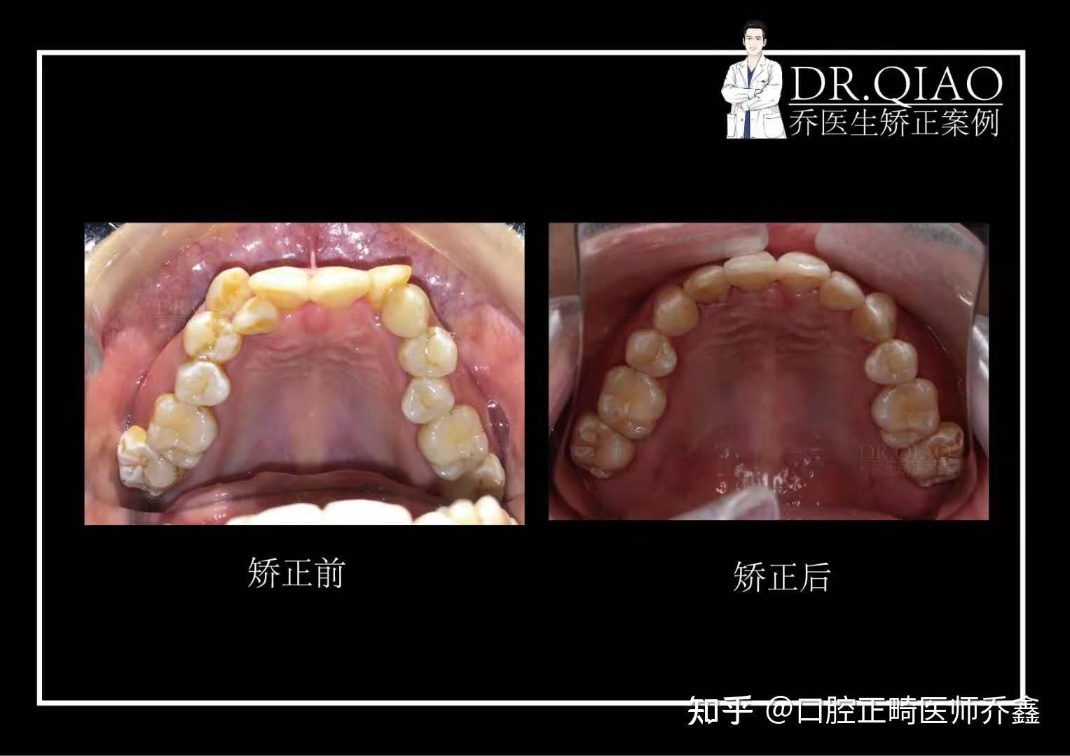 你做过牙齿正畸之后效果怎么样