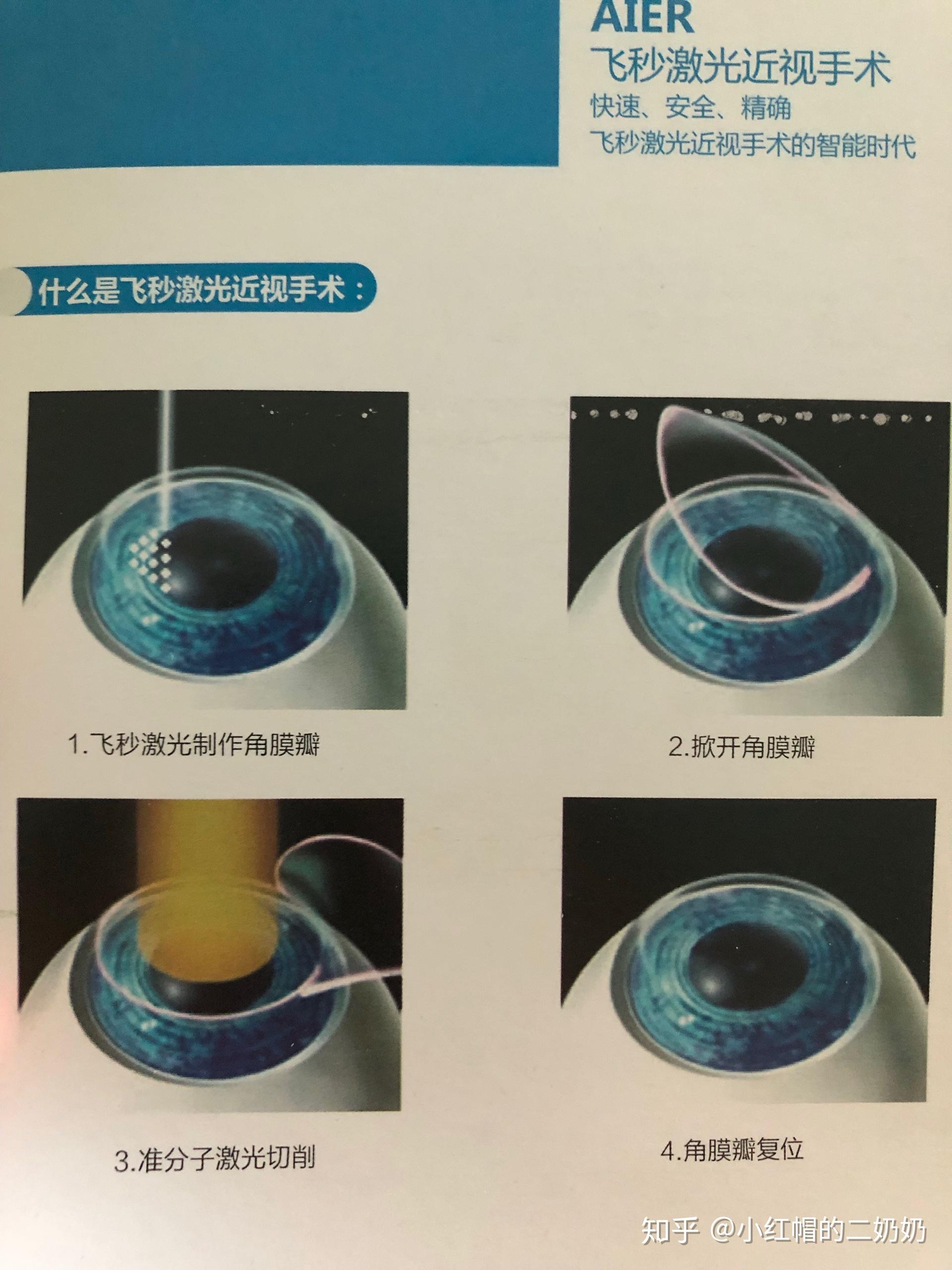 半飞秒术后一周手术过程整理～ - 知乎