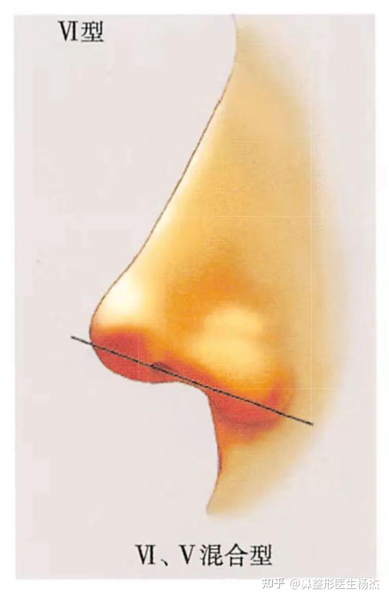 鼻翼与鼻小柱美学分析及临床运用