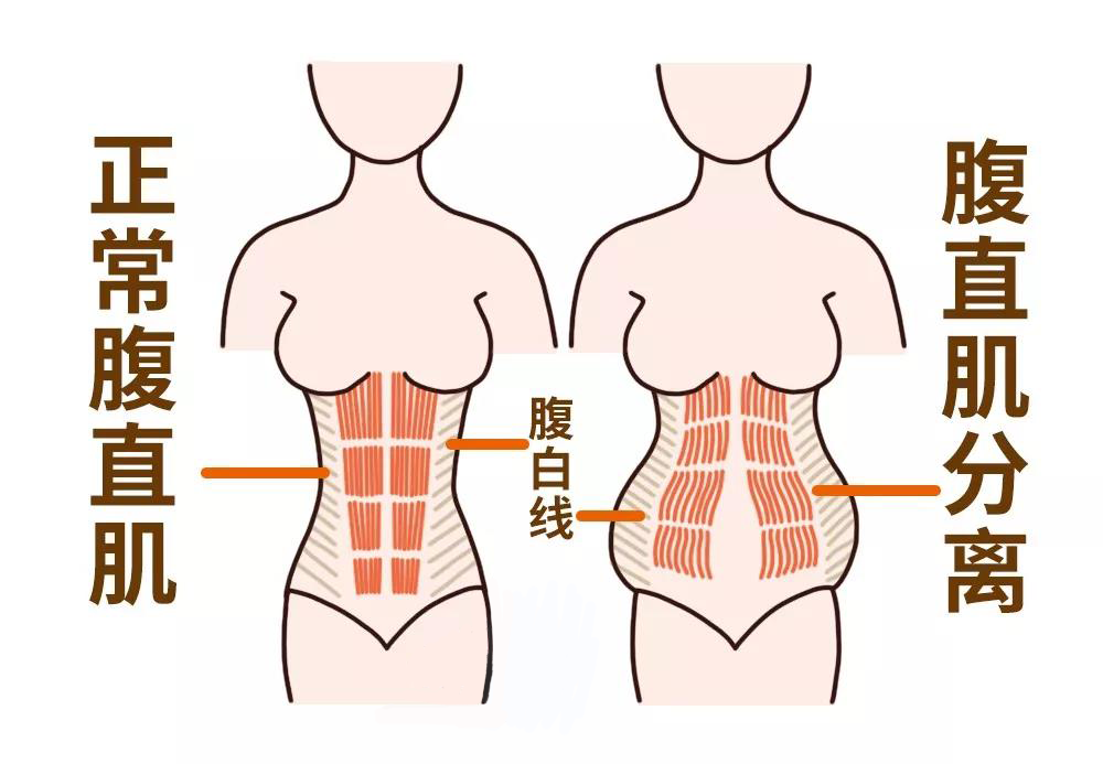 产后腹直肌和盆底肌修复到底应该选哪一个先做哪一个