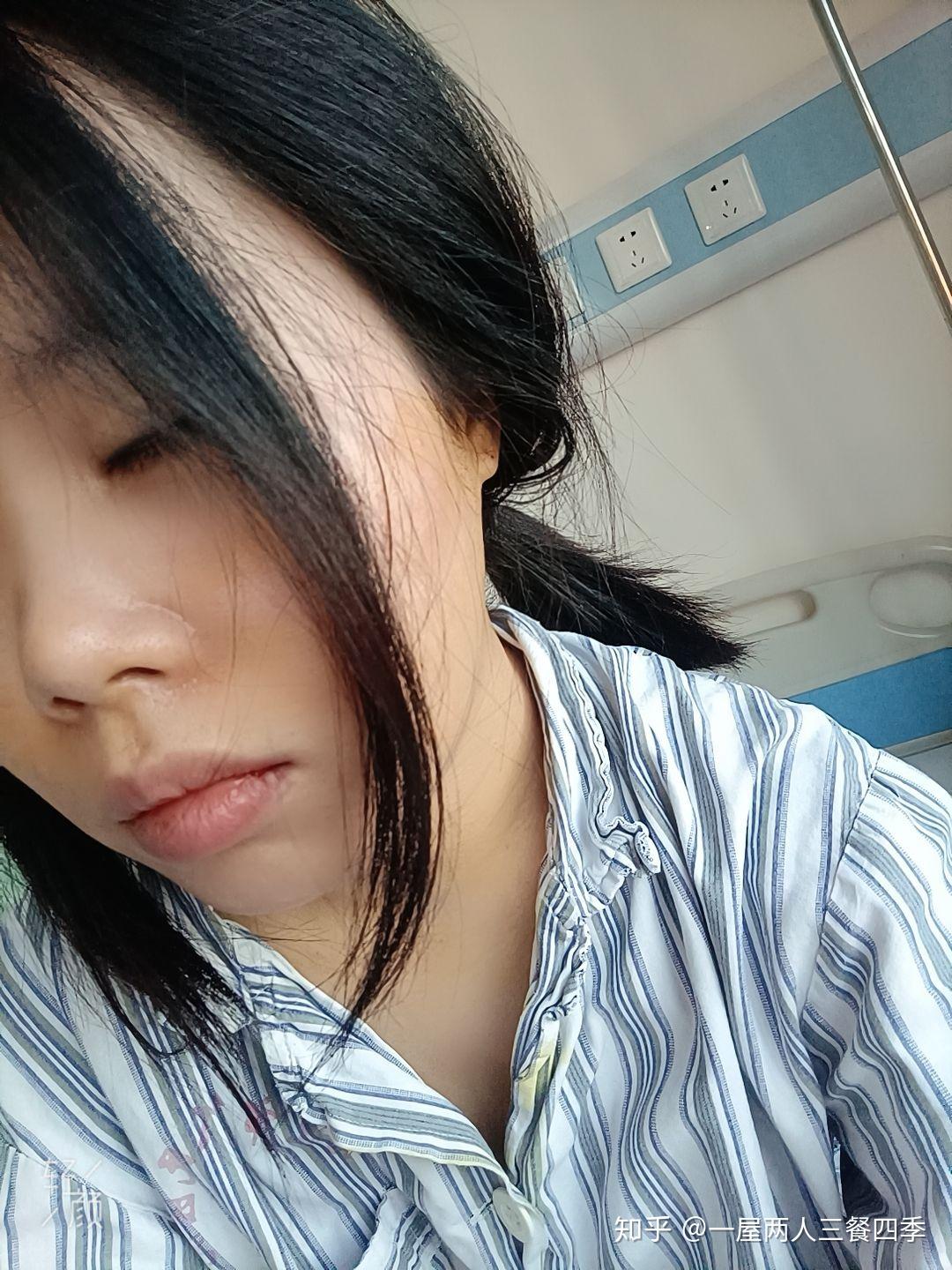舌下腺囊肿手术