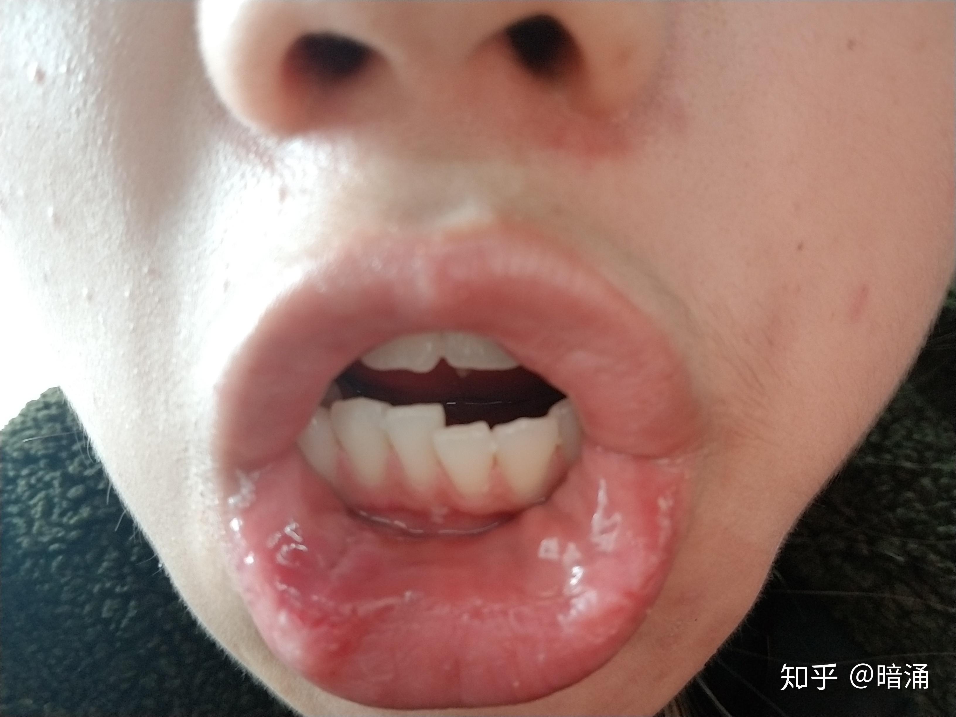 口腔粘液腺瘤图片图片