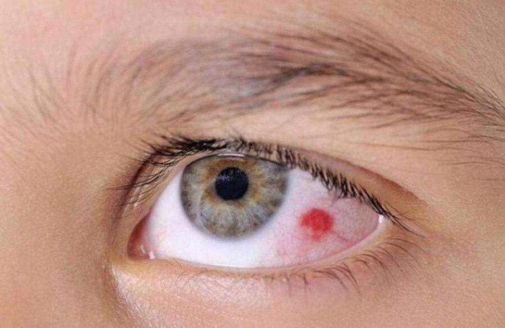 当视网膜萎缩累及黄斑时,可能出现黄斑出血,裂孔,视力严重下降,且有