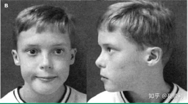 了解先天遗传病变digeorge综合征