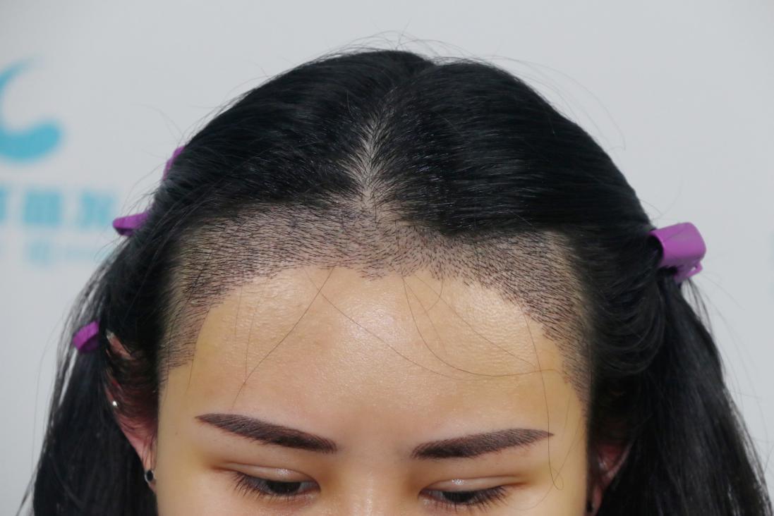 发际线高,头顶稀疏,到底适不适合植发?