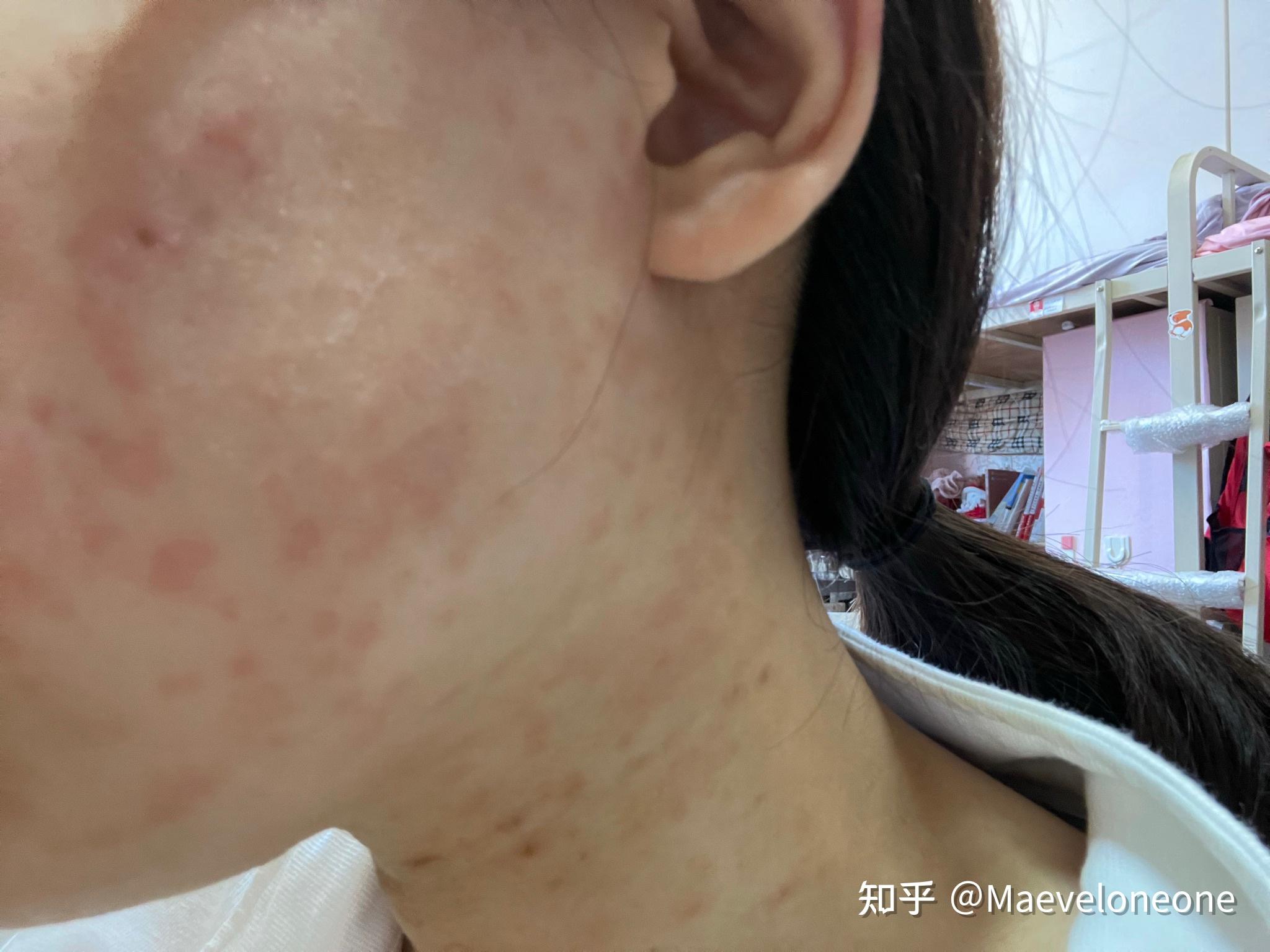 玫瑰糠疹能治好吗 zhuanlan.zhihu.com