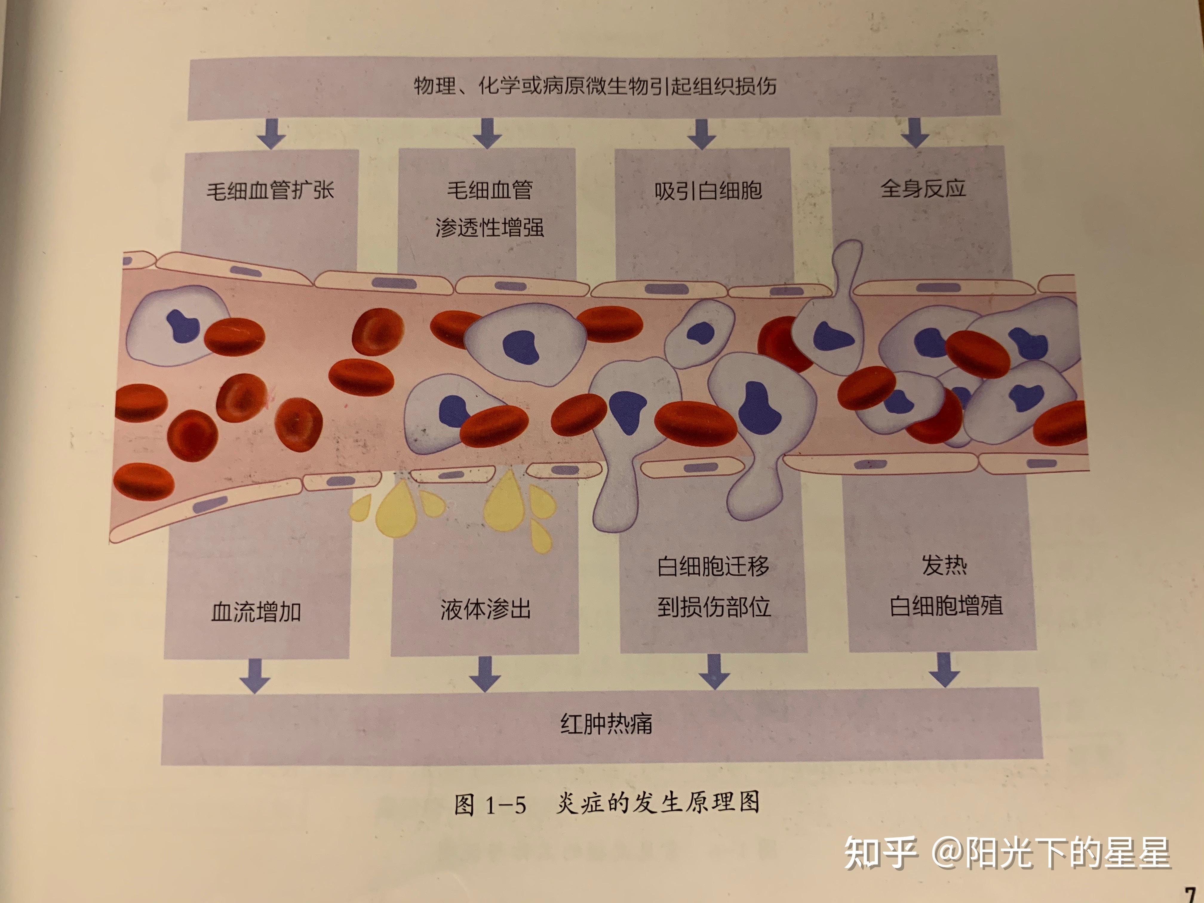 在炎症中,血管最终表现为扩张,血细胞(特别是白细胞) 游出血管,进入