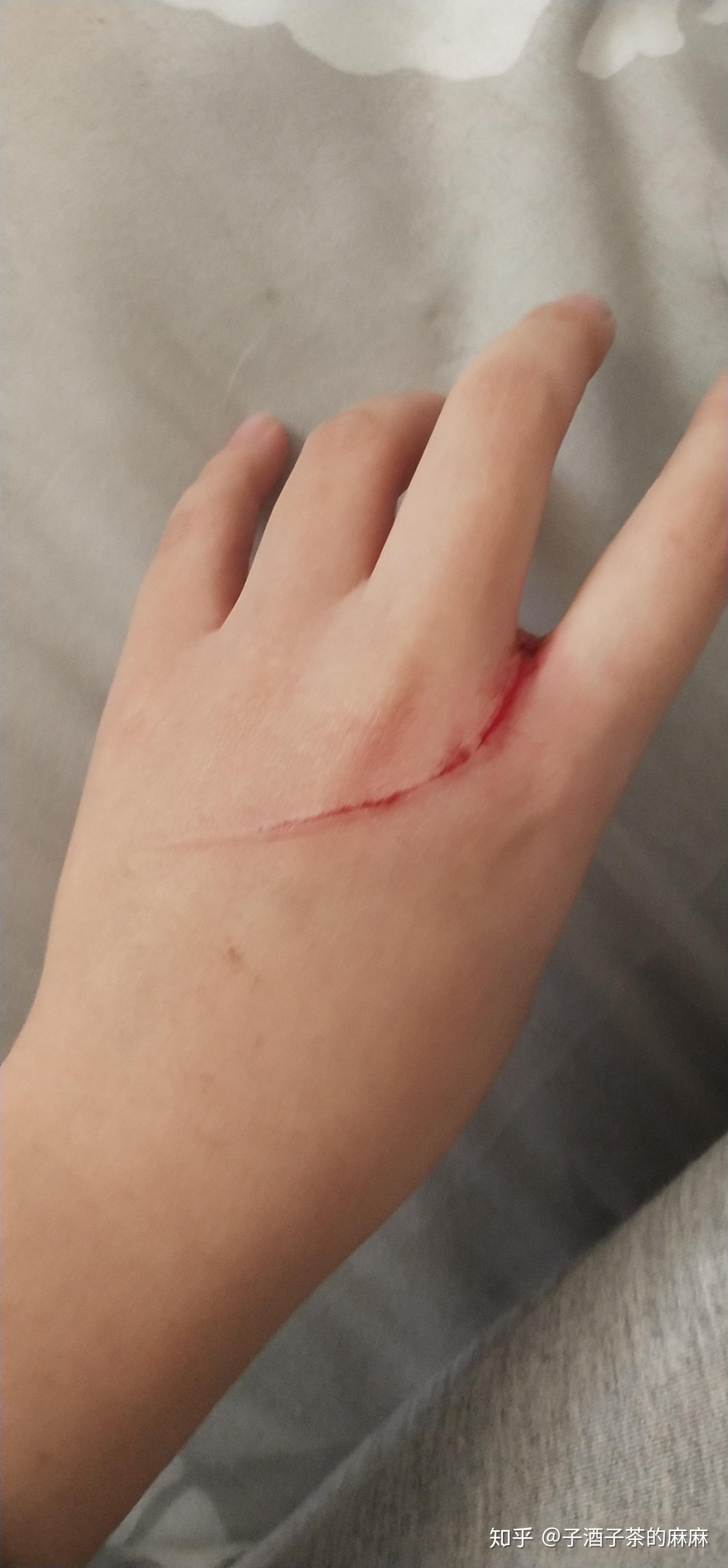 为什么左手被刮伤右手同样位置也痛